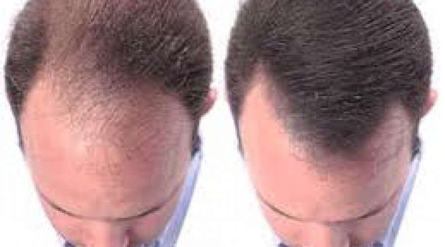 Causas de la caída del pelo, y alimentos que ayudan a fortalecerlo